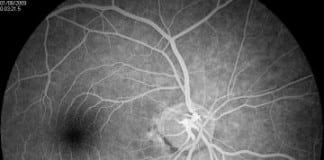 Untreated diabetes can lead to complete vision loss