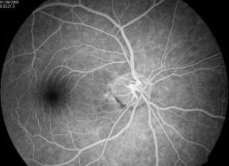 Untreated diabetes can lead to complete vision loss