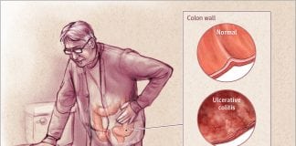Incidence of Inflammatory Bowel Disease on the Rise
