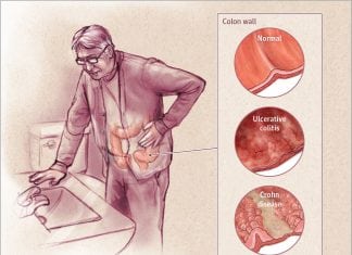 Incidence of Inflammatory Bowel Disease on the Rise