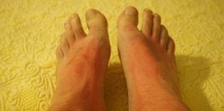 How to Protect against Skin Cancer