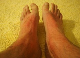 How to Protect against Skin Cancer
