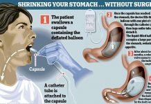 Balloon Capsule Is The New Revolutionary Non-surgical Procedure To Fight Obesity