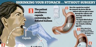 Balloon Capsule Is The New Revolutionary Non-surgical Procedure To Fight Obesity