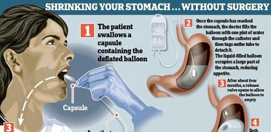 Balloon Capsule Is The New Revolutionary Non-surgical Procedure To Fight Obesity